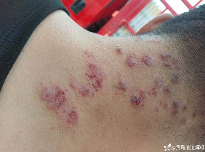 全球新增阳性感染者12例/全球新增阳性感染者12例图片