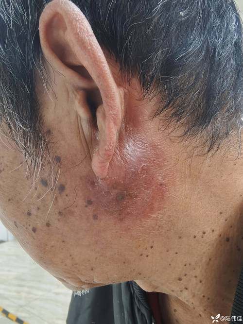  山西长治潞城区现有无症状感染者28例:长治潞州区有一例新型冠状病毒