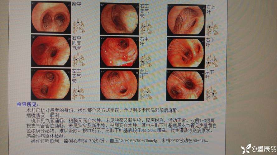  全球新增6例核酸阳性及7例无症状:全球新增6例核酸阳性及7例无症状是什么
