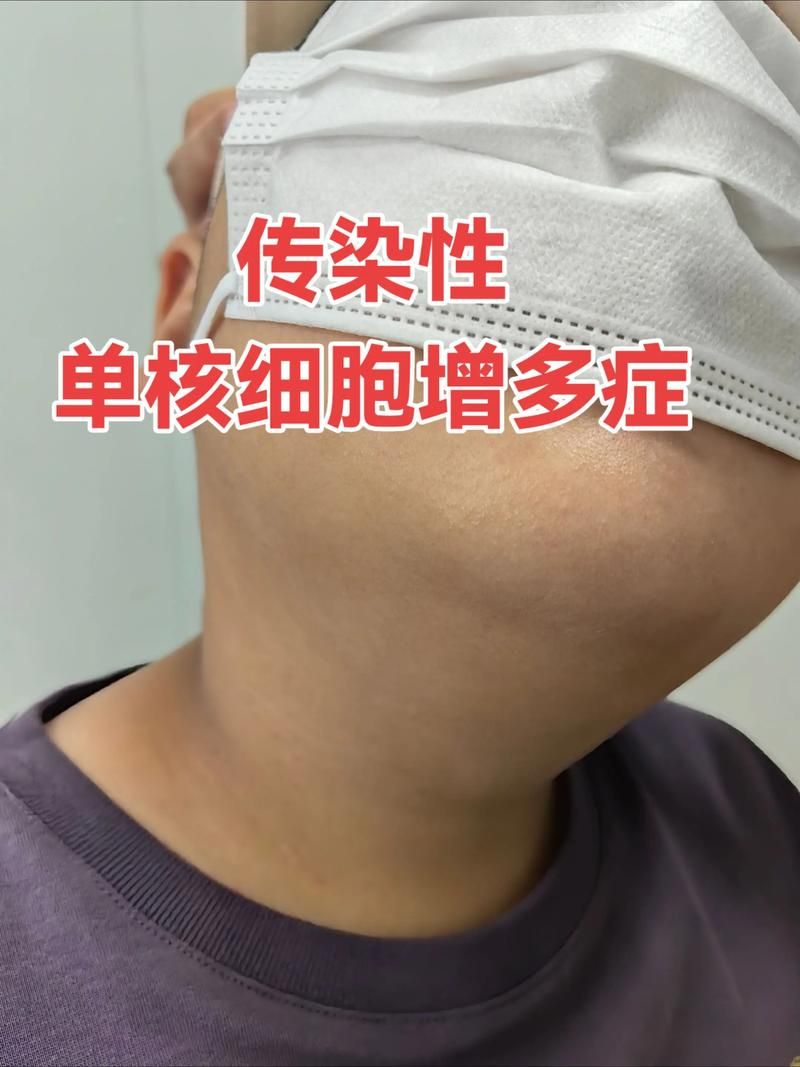 单县现有无症状感染者7例:单县出现一例