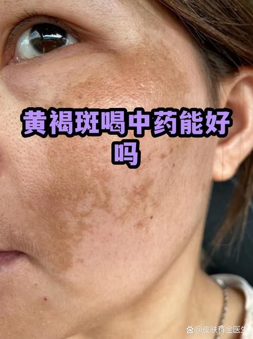  查找阿图什市最新疫情:脸上长黄褐斑看什么科