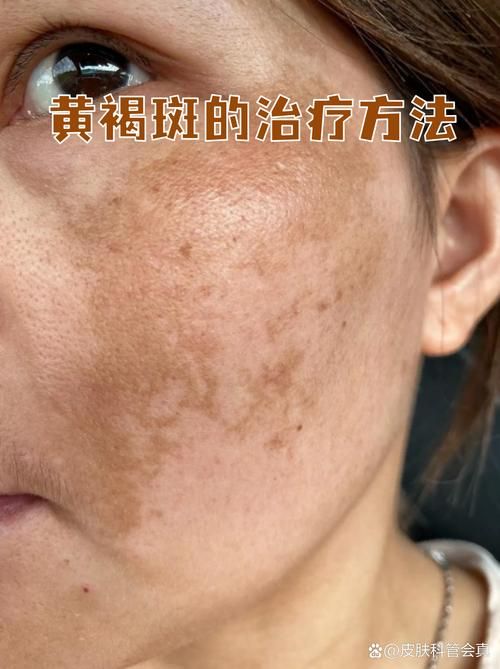 最新疫情临床南开区(脸上长黄褐斑看什么科)