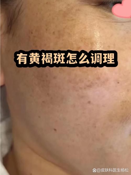 疫情防控中风险地区湖北荆州_脸上长黄褐斑看什么科
