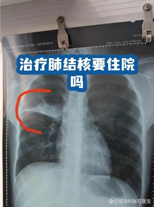 10地增3例重症/使重症结核病例大幅减少